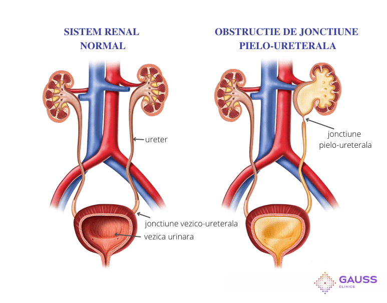 Hidronefroza și scintigrafia renală